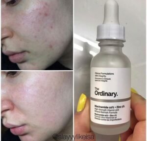 Niacinamide 10% + Zinc 1% – Sérum Anti-Imperfections